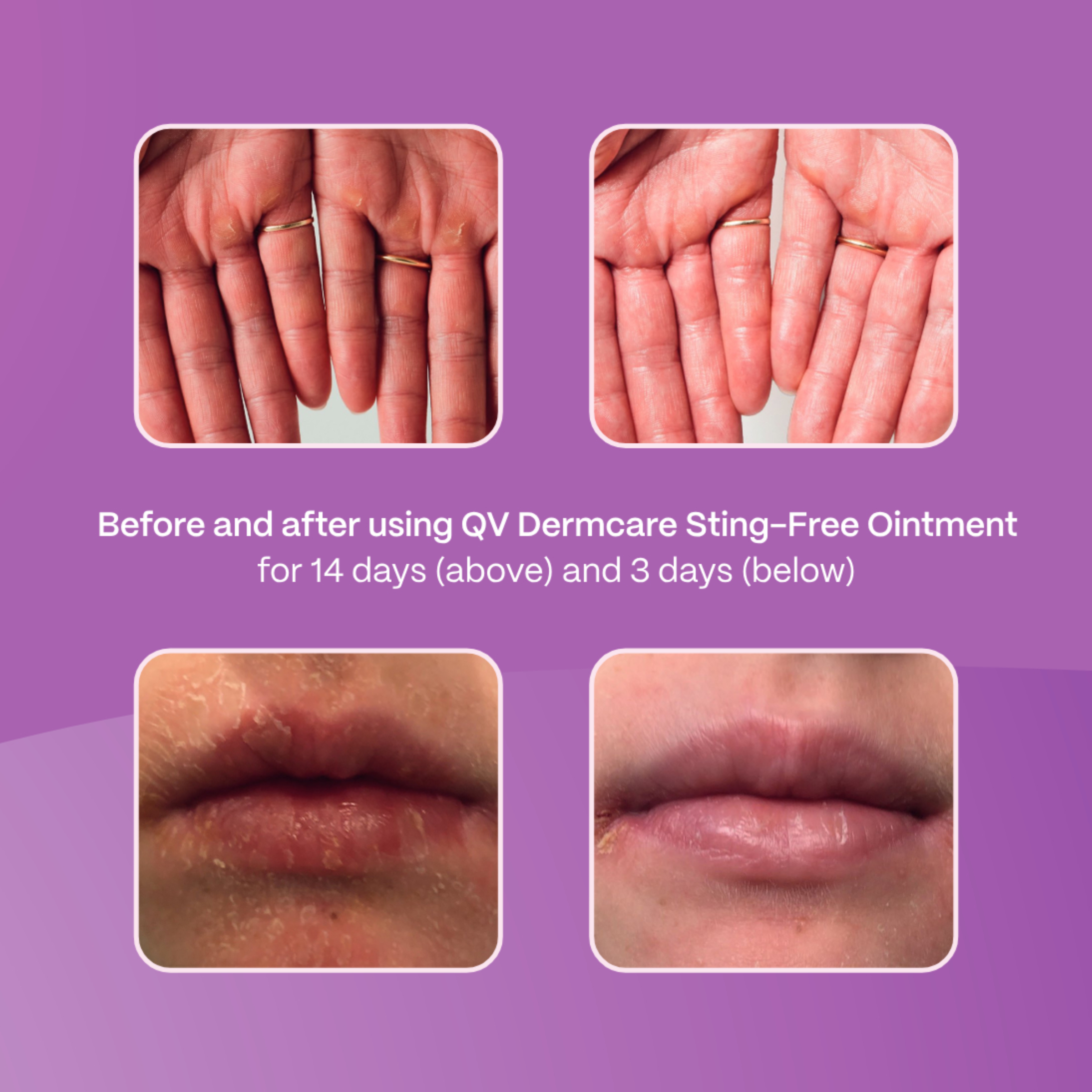 EGO QV DERMCARE STING FREE OINTMENT 100G - Image 7